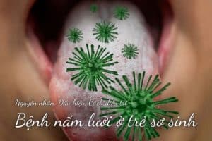 Bệnh nấm lưỡi ở trẻ