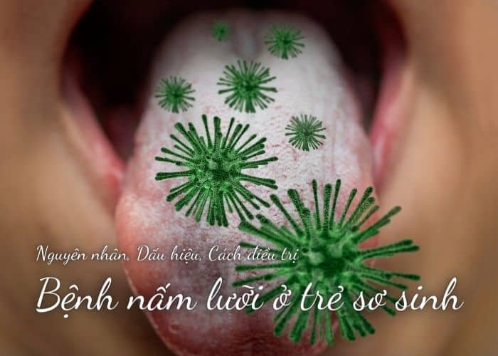 Bệnh nấm lưỡi ở trẻ