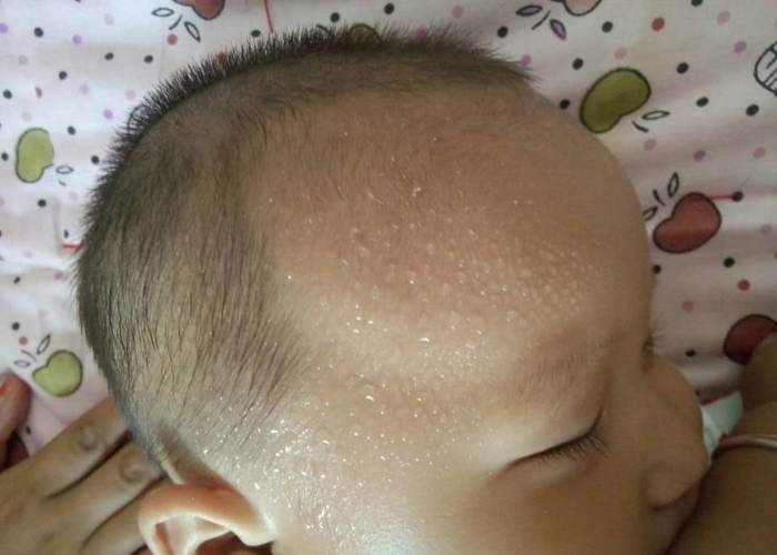 Mồ hôi trộm hay ra nhiều ở vùng đầu của trẻ