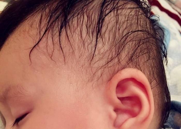 Cháu rất hay ra mồ hôi ở đầu khi ngủ, buổi đêm tôi phải dùng đến 4-5 khăn vải màn để lau mồ hôi mà khăn nào cũng ẩm xì xì