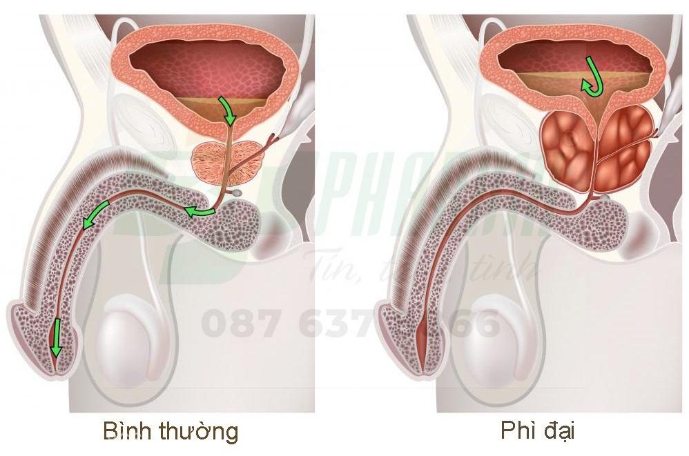 Bị phì đại tuyến tiền liệt