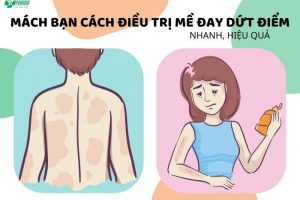 cách điều trị mề đay dứt điểm