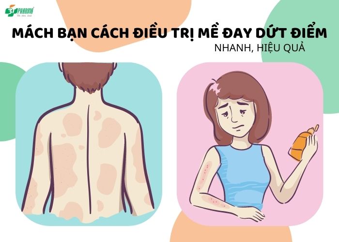 Cách trị dứt điểm mề đay Cách trị dứt điểm mề đay