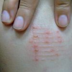 Nguyên nhân đầu tiên khi bạn cảm thấy nằm chiếu trúc bị ngứa là do có mạt(rệp) trong chăn, chiếu, nệm