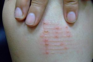 Nguyên nhân đầu tiên khi bạn cảm thấy nằm chiếu trúc bị ngứa là do có mạt(rệp) trong chăn, chiếu, nệm