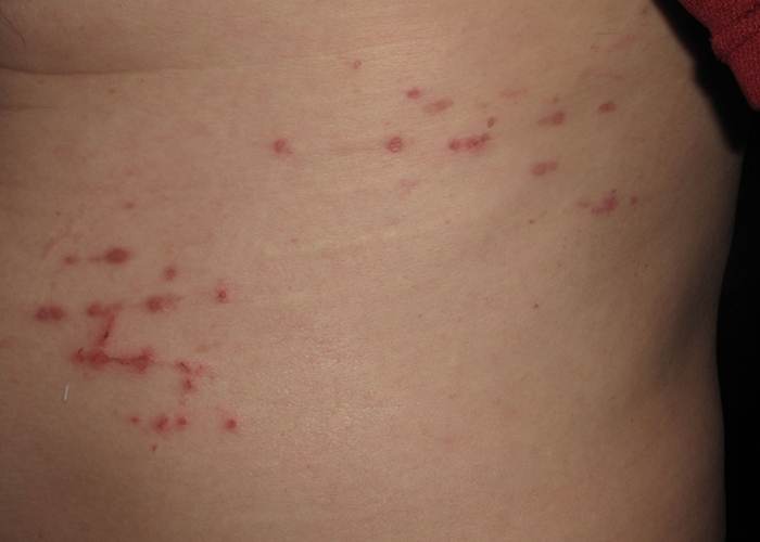 Nằm chiếu trúc bị ngứa