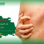 Nổi mụn ngứa ở khắp người - Nguyên nhân do đâu?