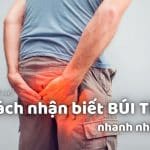 Cách nhận biết BÚI TRĨ