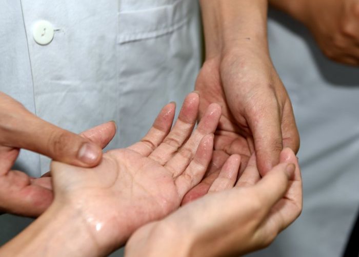 Đổ mồ hôi tay chân do rối loạn thần kinh thực vật