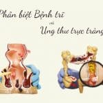 phân biệt bệnh trĩ và ung thư trực tràng