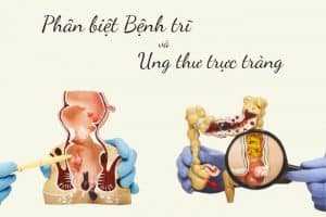 phân biệt bệnh trĩ và ung thư trực tràng