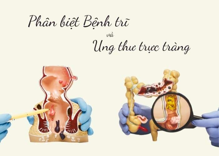 phân biệt bệnh trĩ và ung thư trực tràng