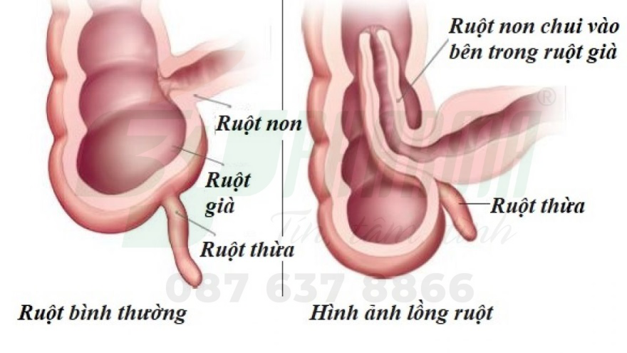Bệnh lồng ruột ở trẻ em