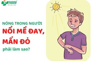 Gặp tình trạng nóng trong người nổi mề đay, mẩn đỏ phải làm sao?