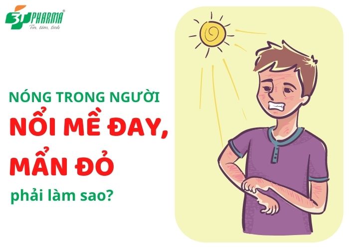 Gặp tình trạng nóng trong người nổi mề đay, mẩn đỏ phải làm sao? Gặp tình trạng nóng trong người nổi mề đay, mẩn đỏ phải làm sao?