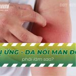 Tình trạng bị dị ứng da nổi mẩn đỏ phải làm sao?