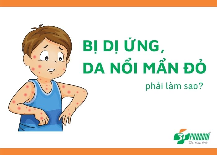 Tình trạng bị dị ứng da nổi mẩn đỏ ngứa phải làm sao? Da bị dị ứng nổi mẩn đỏ nên làm gì