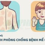 Cách phòng chống bệnh mề đay