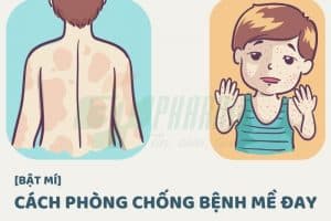 Cách phòng chống bệnh mề đay