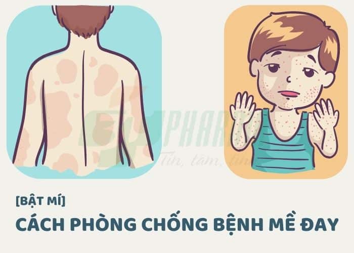 Cách phòng chống bệnh mề đay