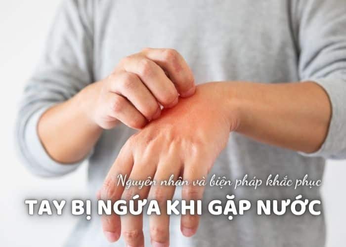 Tay bị nổi mẩn ngứa do nước lạnh, lạ nước bị ngứa phải làm sao?