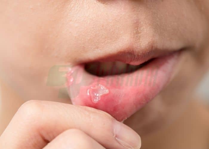 Người hay bị nhiệt miệng có thể bị nhiệt miệng quanh năm Nguyên nhân bị nhiệt miệng thường xuyên
