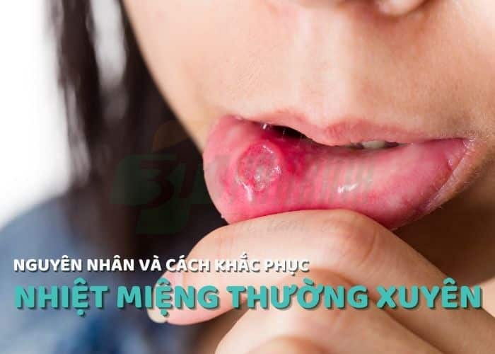 Nguyên nhân bị nhiệt miệng thường xuyên Nguyên nhân bị nhiệt miệng thường xuyên