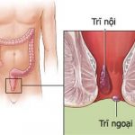Người bệnh trĩ ngoại nên kiêng ăn gì và ăn gì để cải thiện?