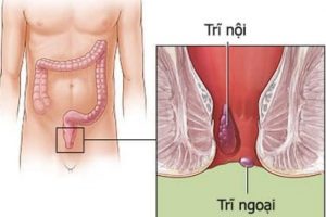Người bệnh trĩ ngoại nên kiêng ăn gì và ăn gì để cải thiện?
