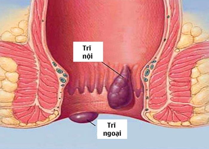 Trĩ ngoại xuất hiện ở ngoài hậu môn, có thể dễ dàng nhận thấy bằng tay hay mắt thường 