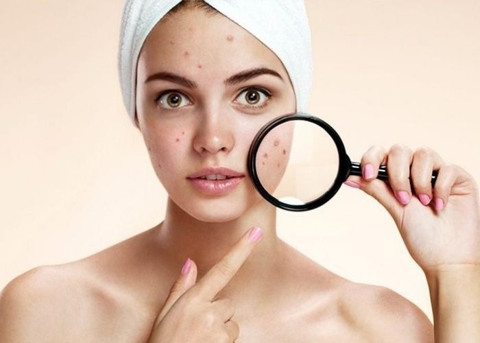 Dị ứng sữa rửa mặt có thẻ khiến mặt bạn xuất hiện mụn ẩn, ngứa rát 