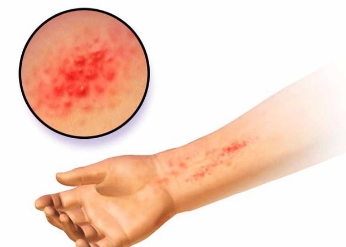 Thành phần trong sữa tắm không phù hợp với làn da cũng là nguyên nhân dẫn đến dị ứng sữa tắm