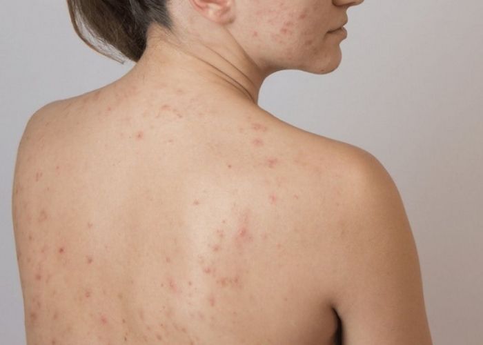 Dị ứng sữa tắm
