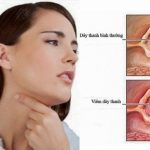 Viêm họng thanh quản cấp tính là gì? Có nguy hiểm không?