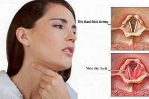 Viêm họng thanh quản cấp tính là gì? Có nguy hiểm không?