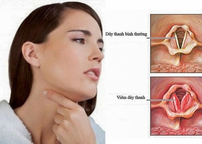 Viêm họng thanh quản cấp tính là gì? Có nguy hiểm không?