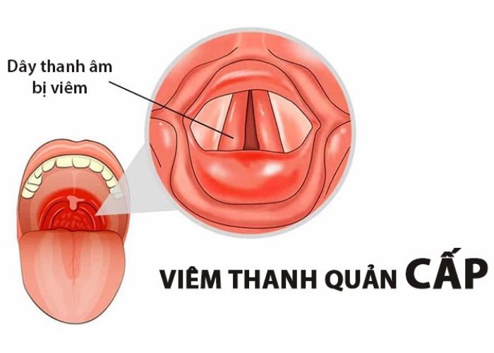 Viêm thanh quản kéo dài trong khoảng 3 tuần được gọi là viêm thanh quản cấp 