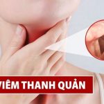 Viêm họng thanh quản mãn tính có nguy hiểm không?