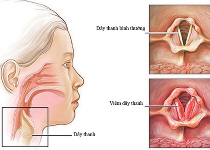 Viêm thanh quản kéo dài chính là nguyên nhân chính dẫn đến viêm thanh quản mãn tính
