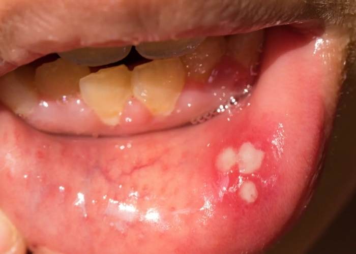 Cách chữa nhiệt miệng là phải tác động đến căn nguyên của nó