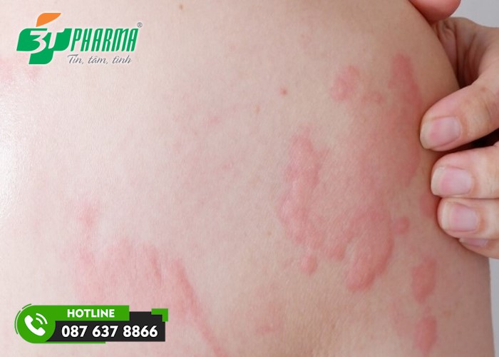 nổi mẩn ngứa khắp người do mề đay - 3T Pharma
