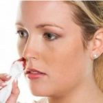 Chảy máu cam có nên nằm ngửa không? - Thói quen sai lầm