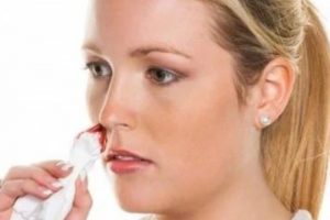 Chảy máu cam có nên nằm ngửa không? - Thói quen sai lầm