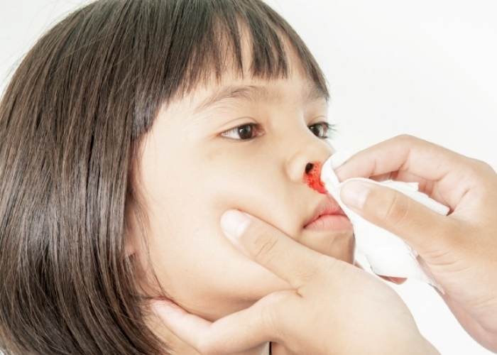 Nguyên nhân chung nhất của tình trạng chảy máu cam nhiều lần trong ngày nên làm gì được giải thích theo Y học cổ truyền