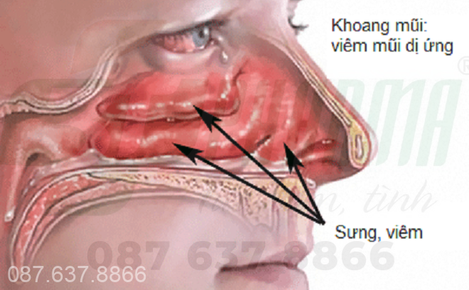 Viêm mũi kéo dài có thể gây chảy máu cam thường xuyên, bị chảy máu cam thường xuyên là bệnh gì