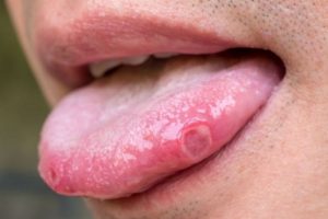 Phải làm sao khi bệnh nhiệt lưỡi hay tái phát?