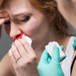 [Góc Giải Đáp] Chảy máu cam có nên ngửa cổ không?