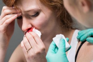 [Góc Giải Đáp] Chảy máu cam có nên ngửa cổ không?