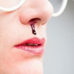 Chảy máu cam do mũi