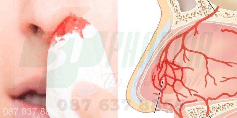 Chảy máu cam do bệnh gì?